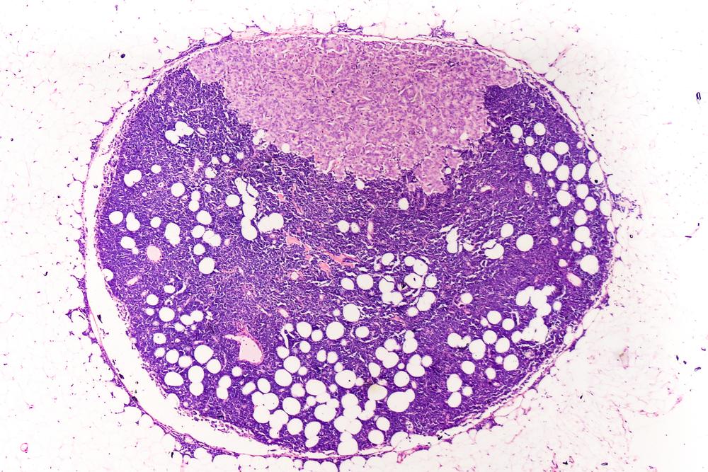 Carcinoma mammario metastatico