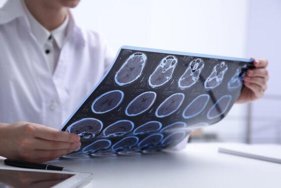 Sclerosi multipla, nuove prospettive di cura e qualità della vita