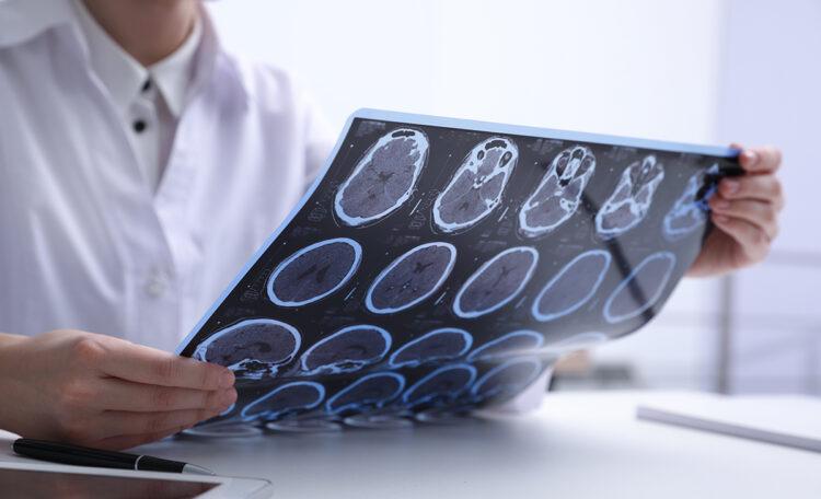 Sclerosi multipla, nuove prospettive di cura e qualità della vita